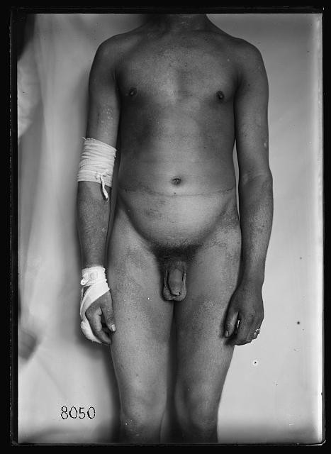 Photo:Bellevue New York City NY 1918 Gas Burns Skin Diseases Male Patient