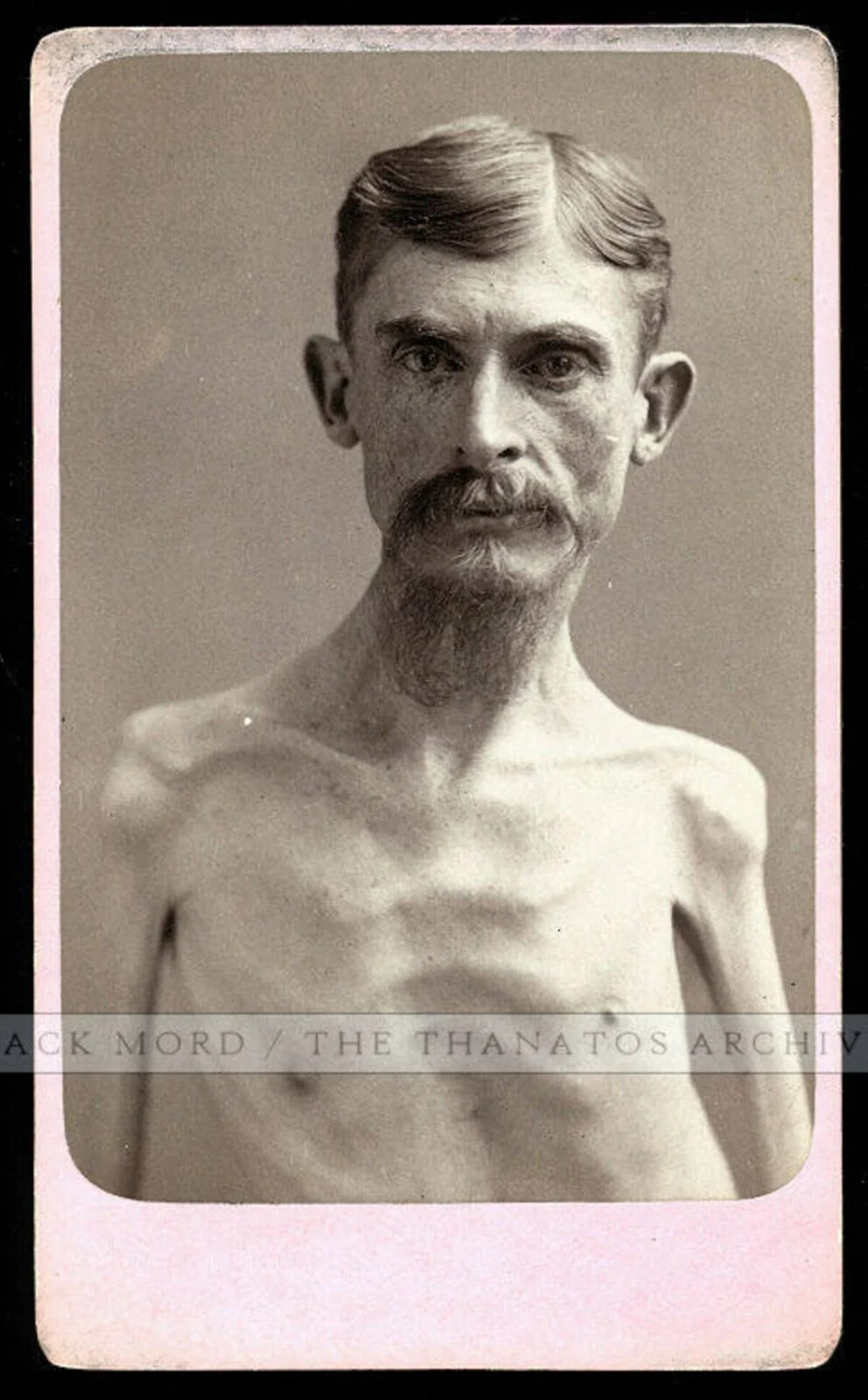 Unpublished Eisenmann Test Shot Ultra Rare CDV Photo Skeleton Man Antique