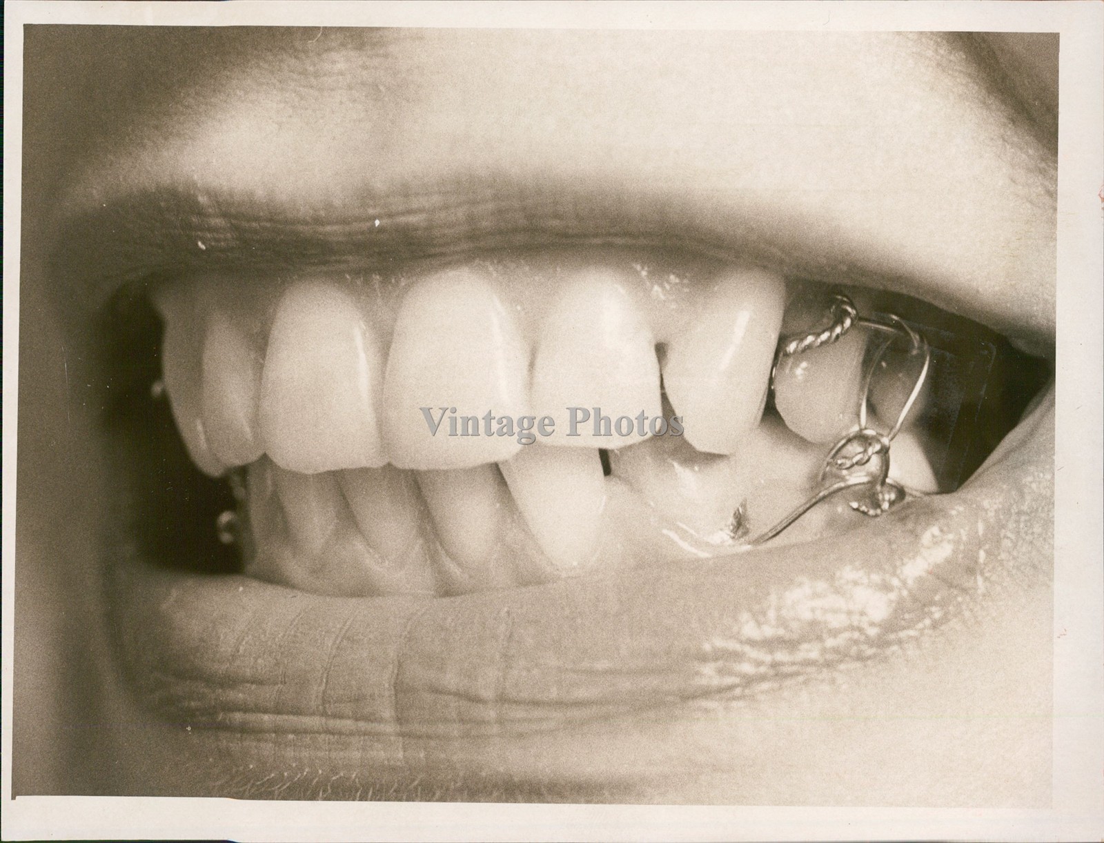 1975 Dieters Jaws Wired Shut Dental Braces January Historic Vintage Photo 7x9