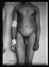 Photo:Bellevue New York City NY 1918 Gas Burns Skin Diseases Male Patient picture